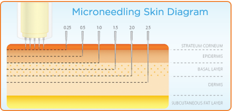 microneedling benefits