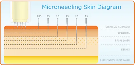 microneedling benefits