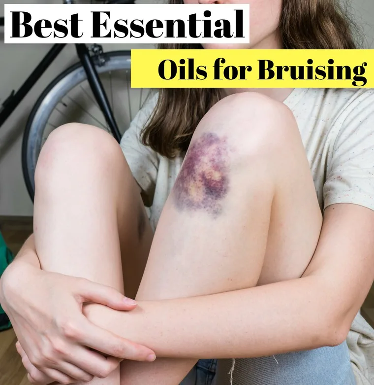 best essential oils for bruising and swelling