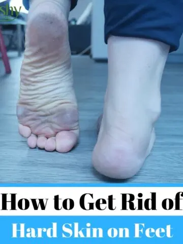 how to get rid of dead skin on feet tips