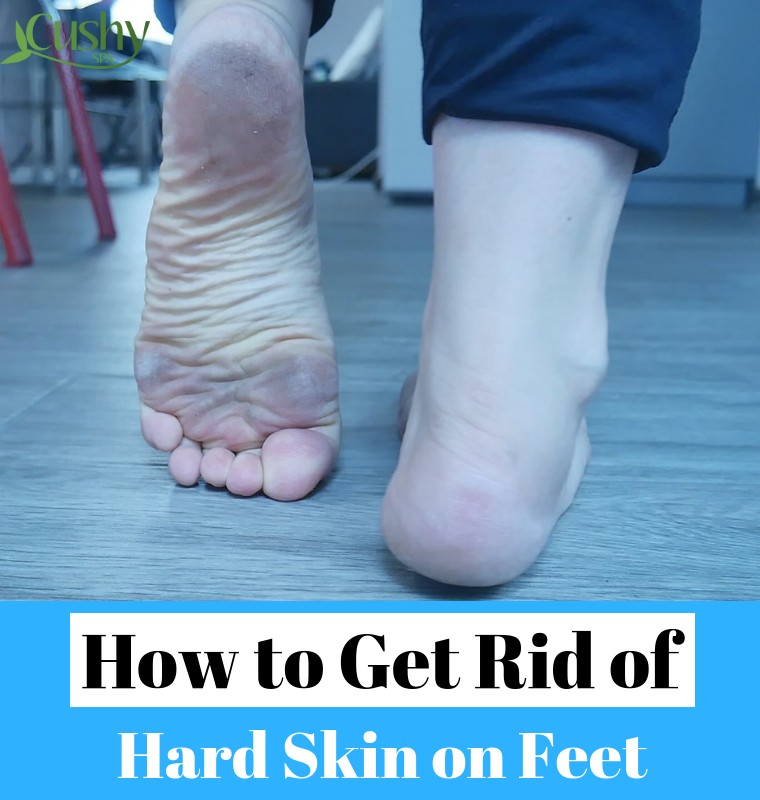 how to get rid of dead skin on feet tips