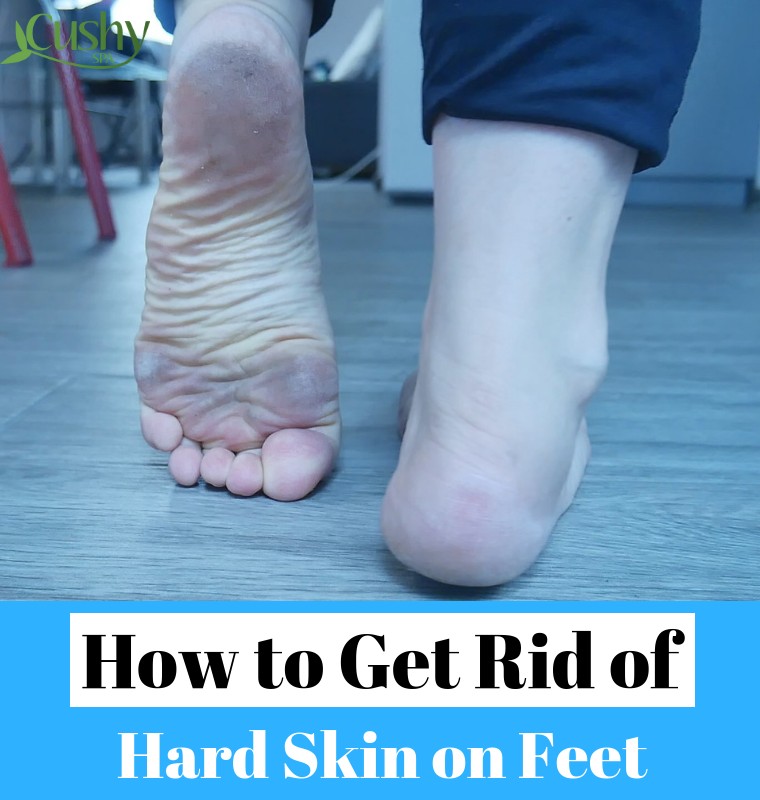 hard skin under the feet