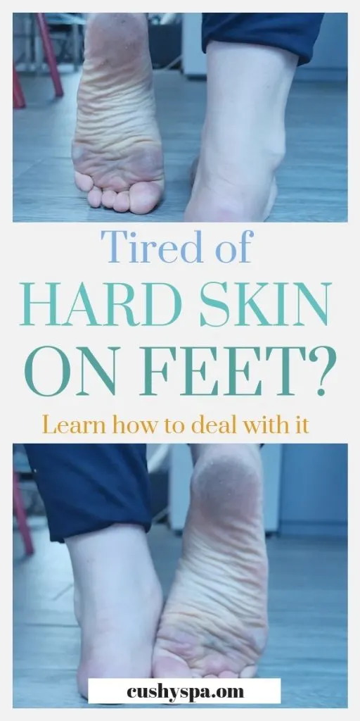 tired of hard skin on feet. learn how to deal with it. (1)