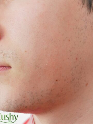 best acne treatment for men