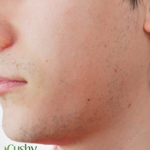 best acne treatment for men