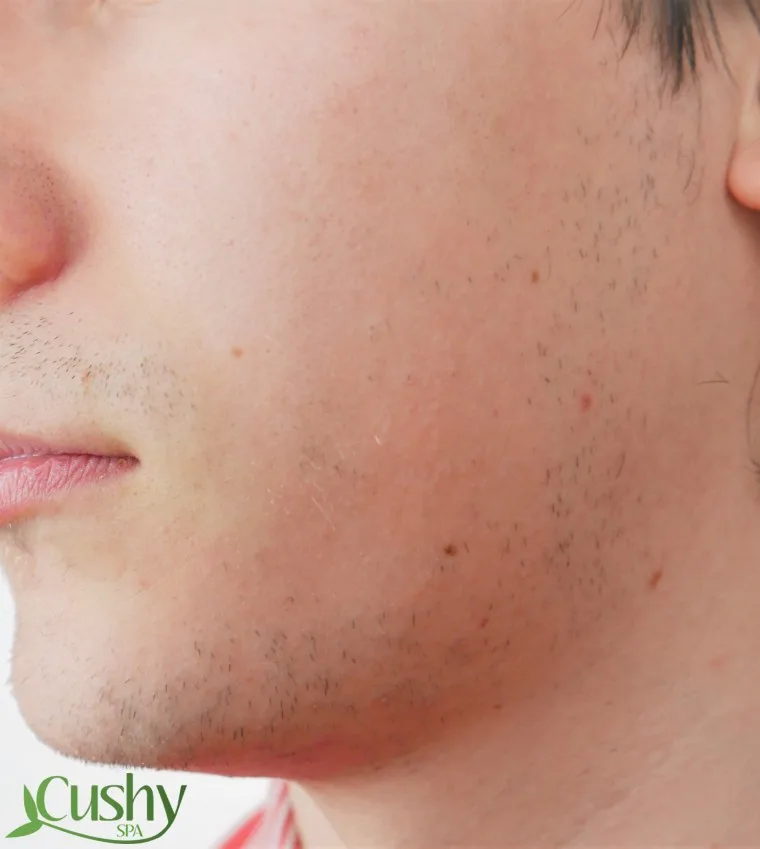 best acne treatment for men