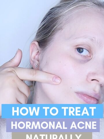 how to treat hormonal acne naturally