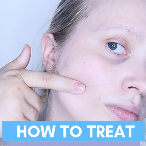 how to treat hormonal acne naturally