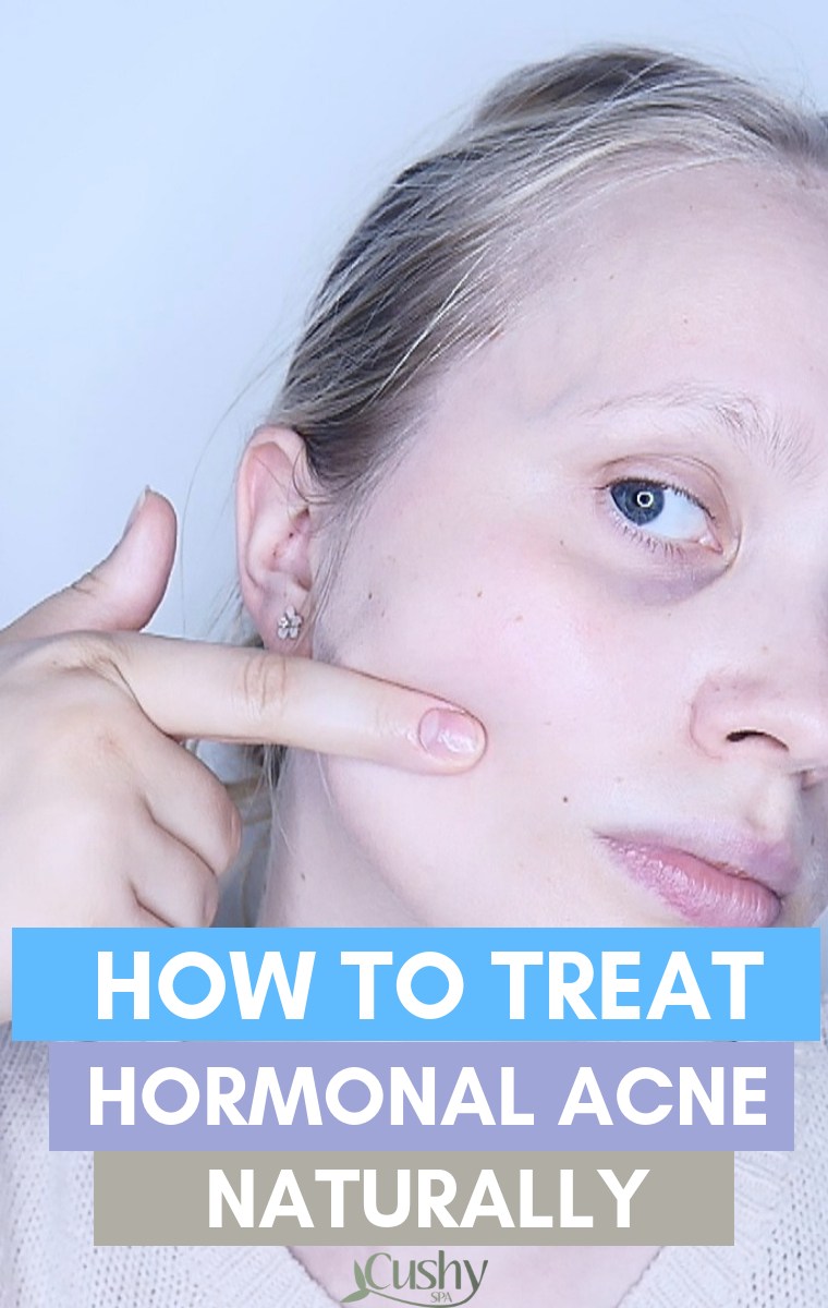how to treat hormonal acne naturally